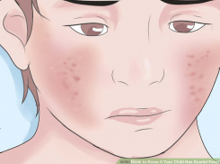 В Воронежской области в 9 раз увеличилась заболеваемость скарлатиной