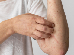 В Воронежской области резко возросла заболеваемость ветрянкой