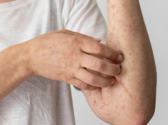 Заболеваемость ветряной оспой и корью снизилась почти в два раза в Воронежской области