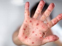 В Воронежской области зарегистрировано шесть случаев заболевания корью