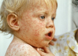 Врачи Воронежской области опасаются вспышки кори в регионе