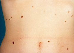 Борисоглебцам на заметку. 5 признаков меланомы, или бегом к врачу.