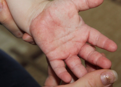 39 человек заболели чесоткой в Воронежской области с начала года