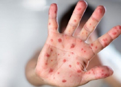 В Воронежской области зарегистрировано шесть случаев заболевания корью