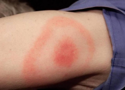 В Воронежской области клещи заразили болезнью Лайма 32 человека