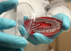 Врачи рассказали о состоянии воронежца, заразившегося сибирской язвой 