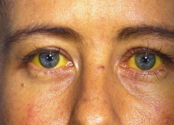 Жители Воронежской области стали чаще болеть вирусным гепатитом С