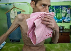 В 2017 году в Борисоглебске от туберкулеза умерло 5 человек