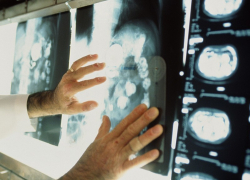 Катастрофический рост смертности от рака объяснили воронежские врачи