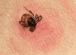 За неделю в Воронежской области от клещей пострадало 264 человека