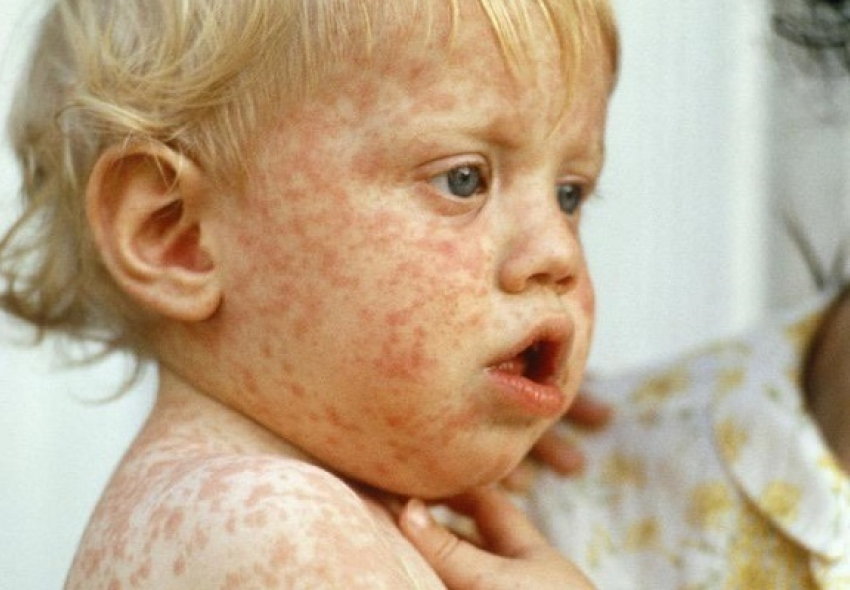 Врачи Воронежской области опасаются вспышки кори в регионе