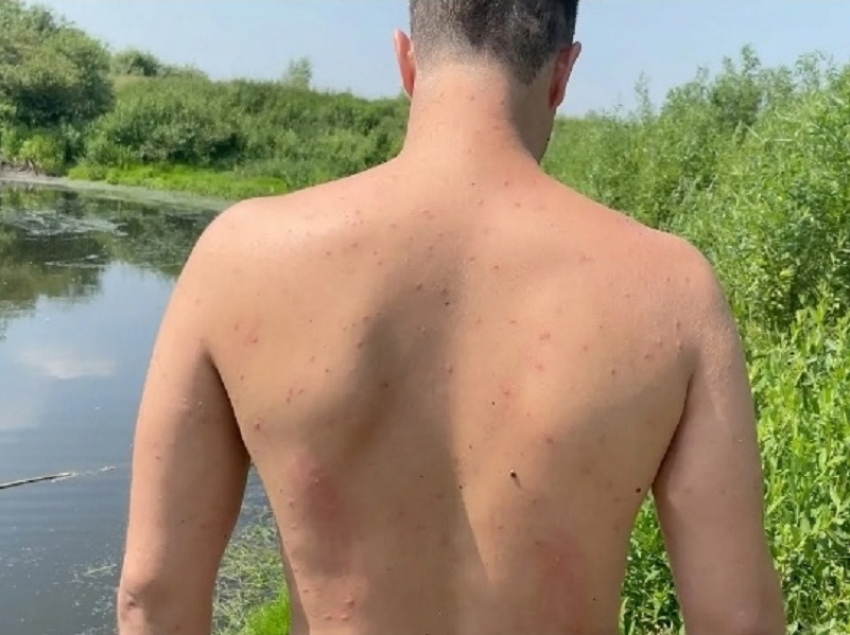 Как спастись от «зуда купальщика», рассказали специалисты