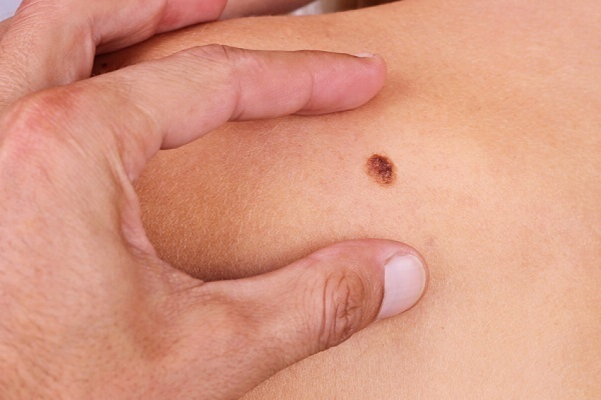 Медики Воронежской области через соцсети проводят бесплатную диагностику рака кожи