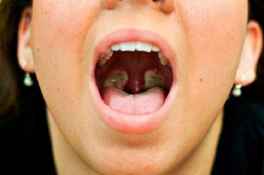 Жителей Воронежской области предупреждают о вспышке дифтерии