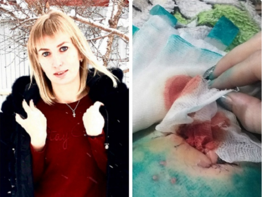 Прооперированную женщину выписали из Борисоглебской РБ с дыркой в животе